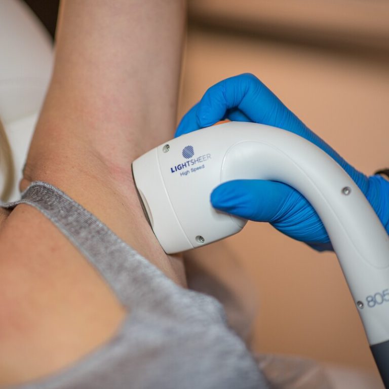 Depilacja laserowa LightSheer - VS Akademia Urody Łódż Złotno 56